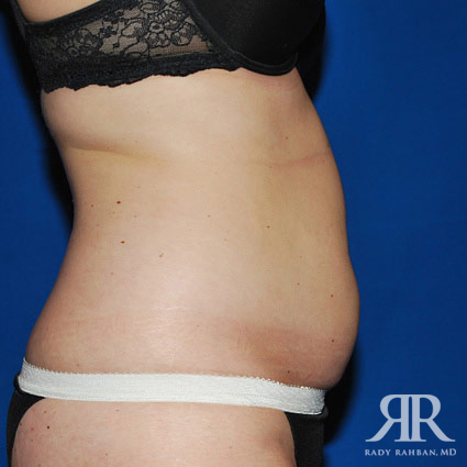 Liposuction