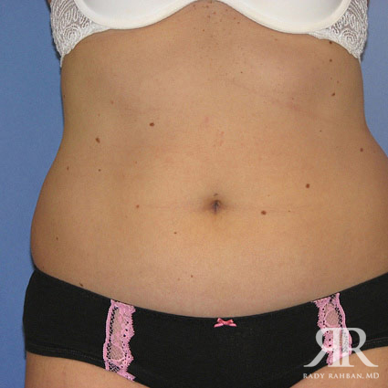 Liposuction