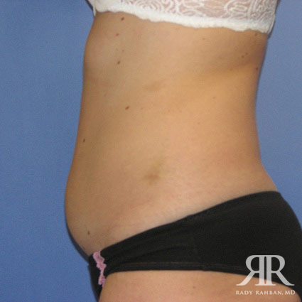 Liposuction