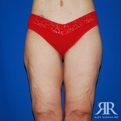 Thigh Lift Before & After Photo 01