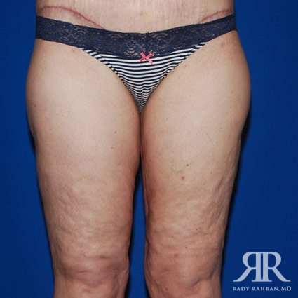 Thigh Lift Before & After Photo 03