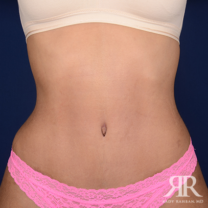 Tummy Tuck Before & After Video 01