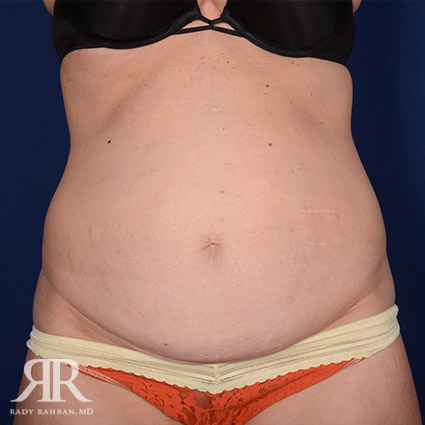 Tummy Tuck