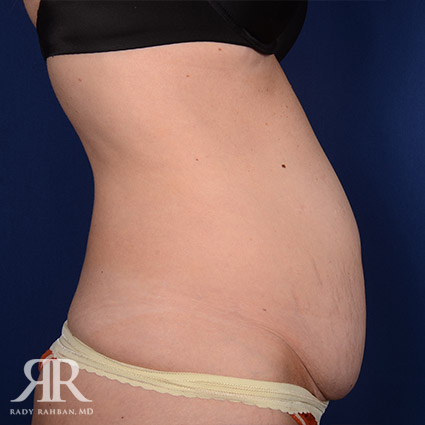 Tummy Tuck