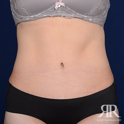 Tummy Tuck Before & After Picture 01