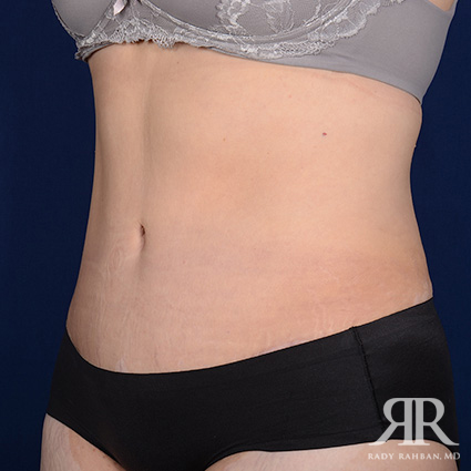 Tummy Tuck