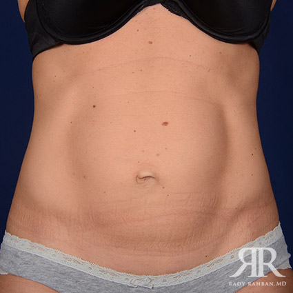 Extended Tummy Tuck Post Pregnancy