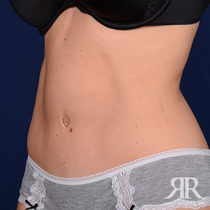 Tummy Tuck