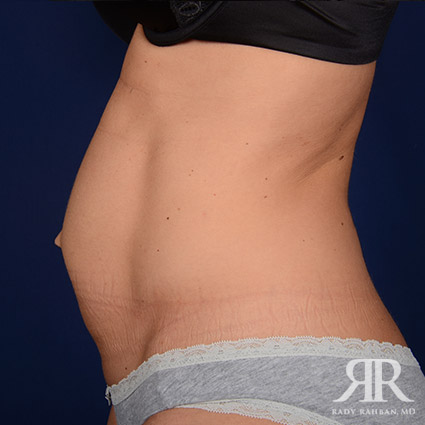 Tummy Tuck