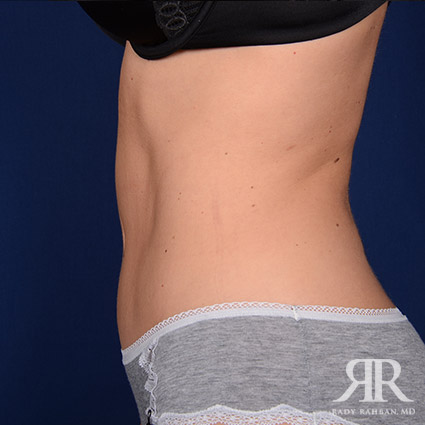 Tummy Tuck