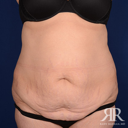 Mini Tummy Tuck After Pregnancy