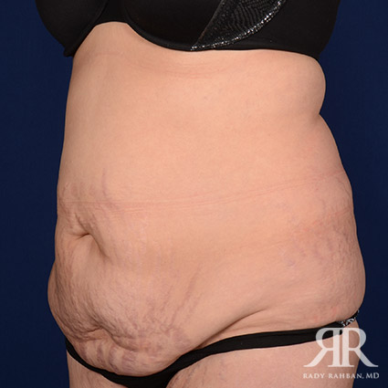 Post Pregnancy Mini Tummy Tuck