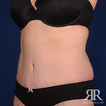 Postpartum Mini Tummy Tuck