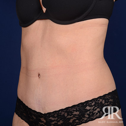 Tummy Tuck