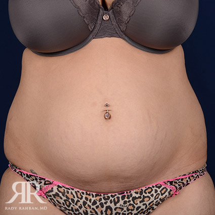 Tummy Tuck