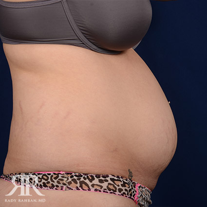 Tummy Tuck