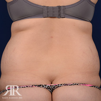 Tummy Tuck