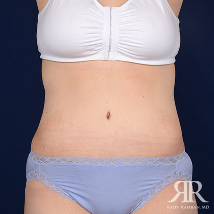 Tummy Tuck