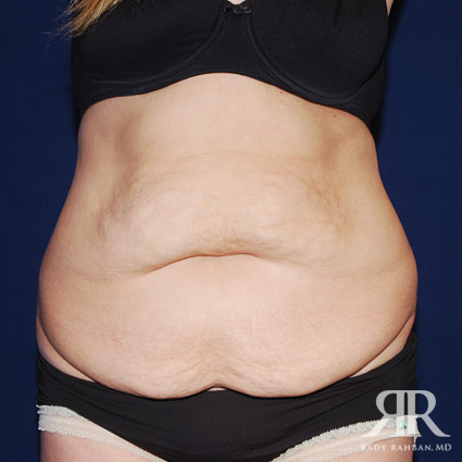 Tummy Tuck