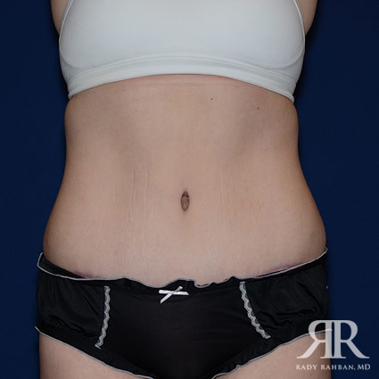 Tummy Tuck