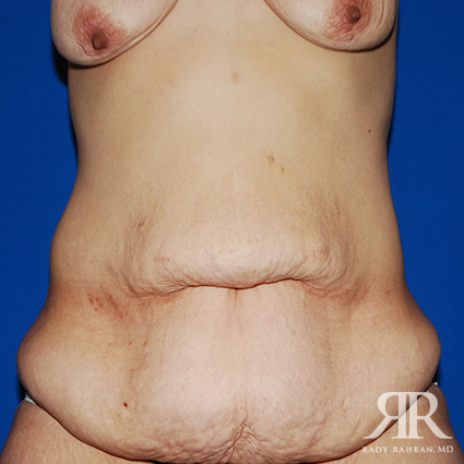 Tummy Tuck