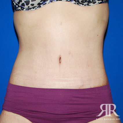 Tummy Tuck