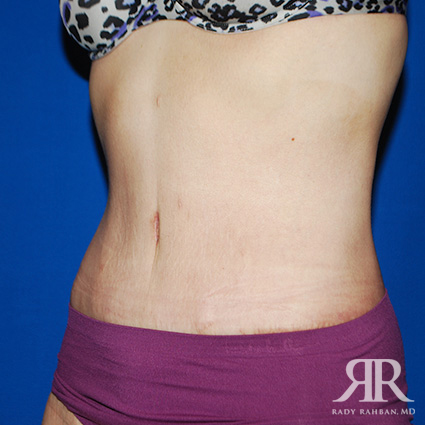 Tummy Tuck