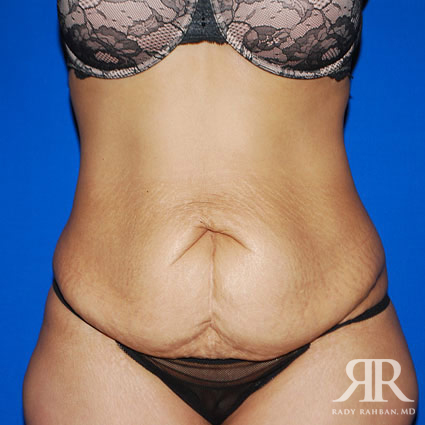 Tummy Tuck