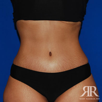 Tummy Tuck