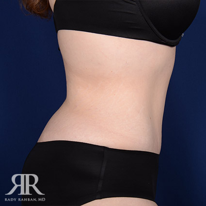 Tummy Tuck