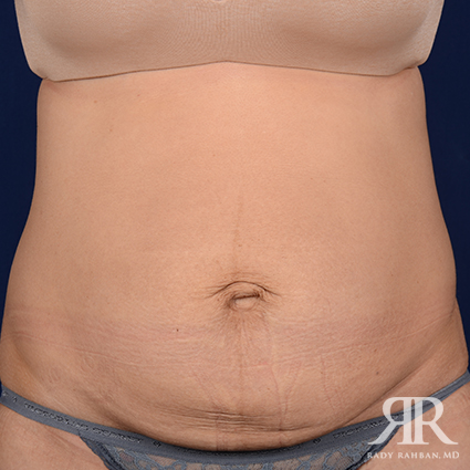 Tummy Tuck