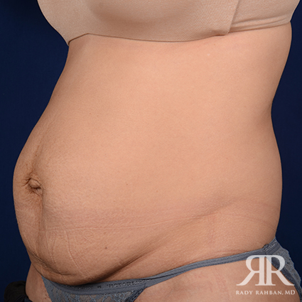 Tummy Tuck