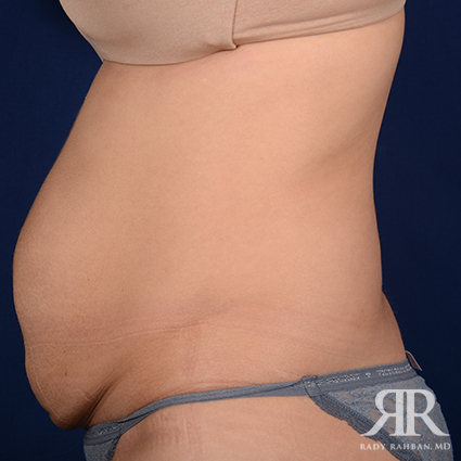 Tummy Tuck