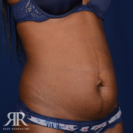 Tummy Tuck