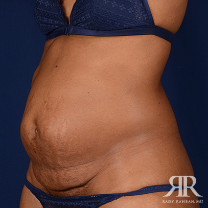 Tummy Tuck