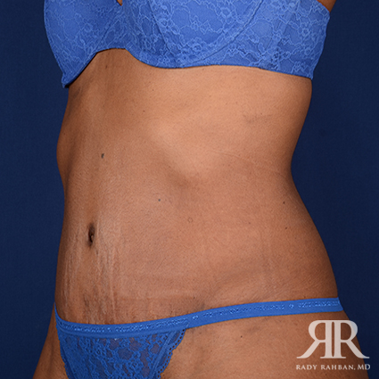 Tummy Tuck