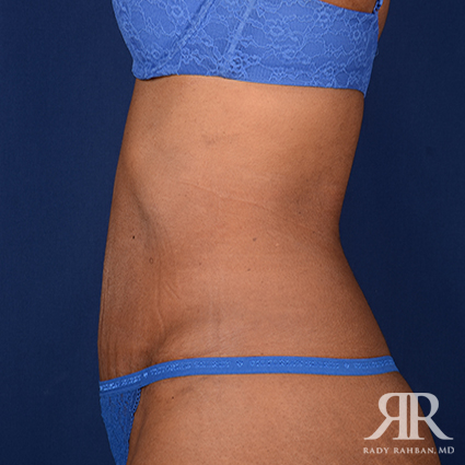 Tummy Tuck