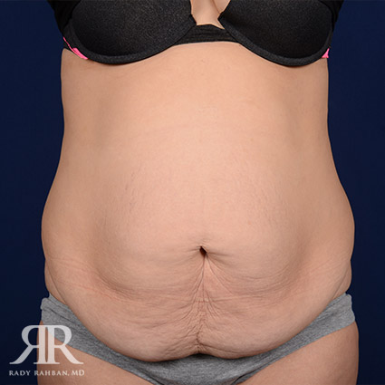 Tummy Tuck