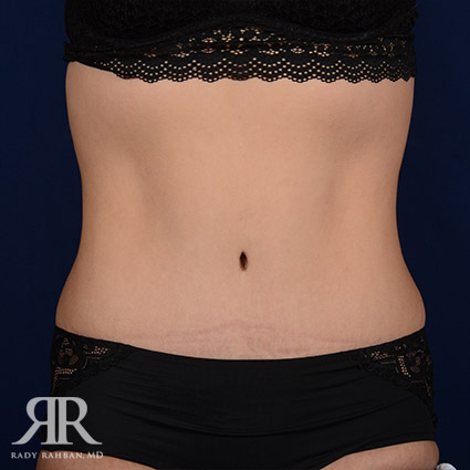 Tummy Tuck