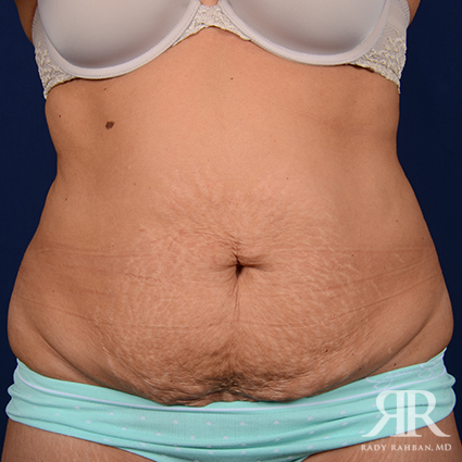 Tummy Tuck