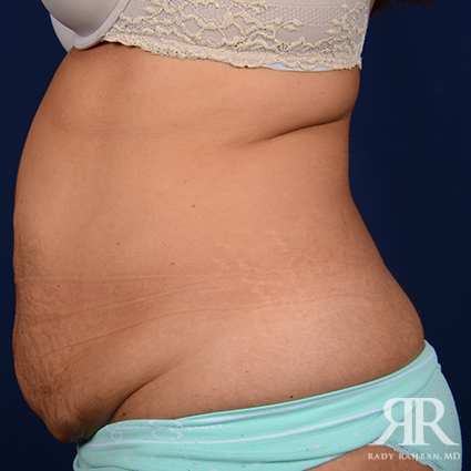 Tummy Tuck
