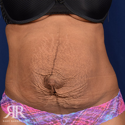 Tummy Tuck