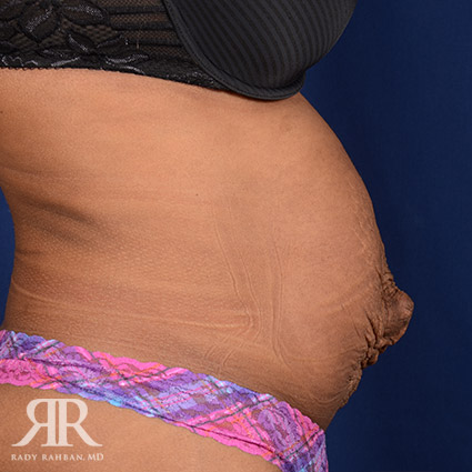 Tummy Tuck