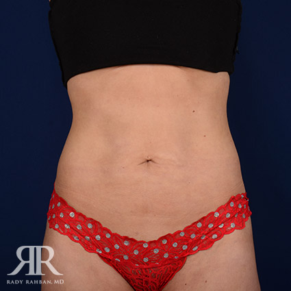 Tummy Tuck