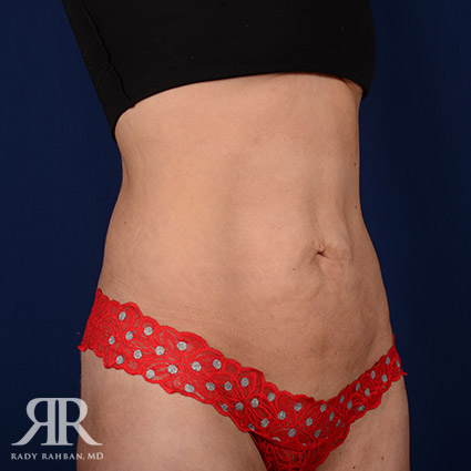 Tummy Tuck