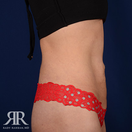 Tummy Tuck