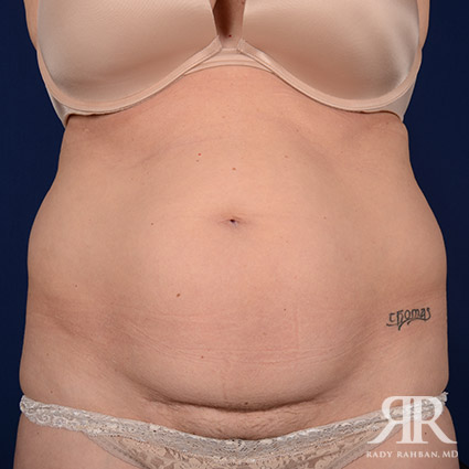 Tummy Tuck