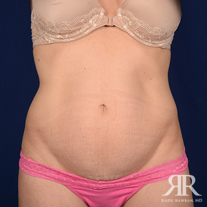 Tummy Tuck