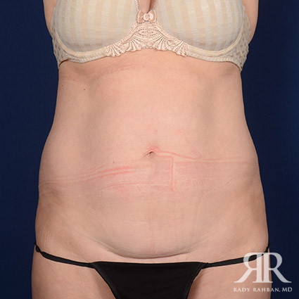 Tummy Tuck