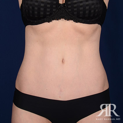 Tummy Tuck